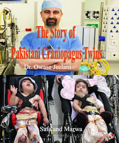 The Story of Pakistani Craniopagus Twins